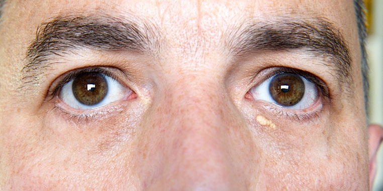 Eyelid Growths